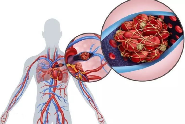 دکتر آمبولی ریه - شیراز